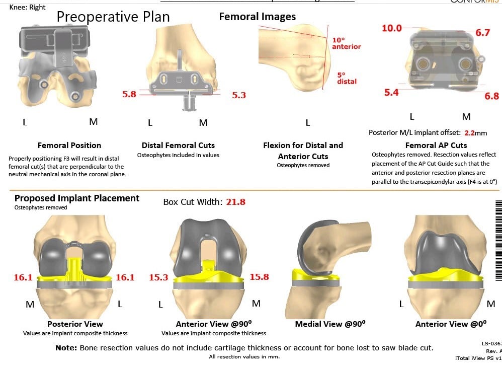 Complete Orthopedics patient specific surgical plan for a Custom Right Total Knee Arthroplasty - 62-year-old male - scan 2