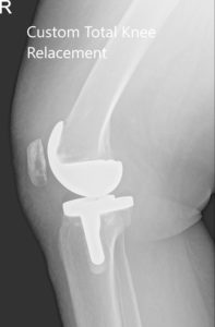Radiografía postoperatoria de la rodilla derecha del paciente que muestra AP y vistas laterales - img 2