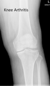 Pre-operative X-ray of the left knee showing AP and lateral views - img 2