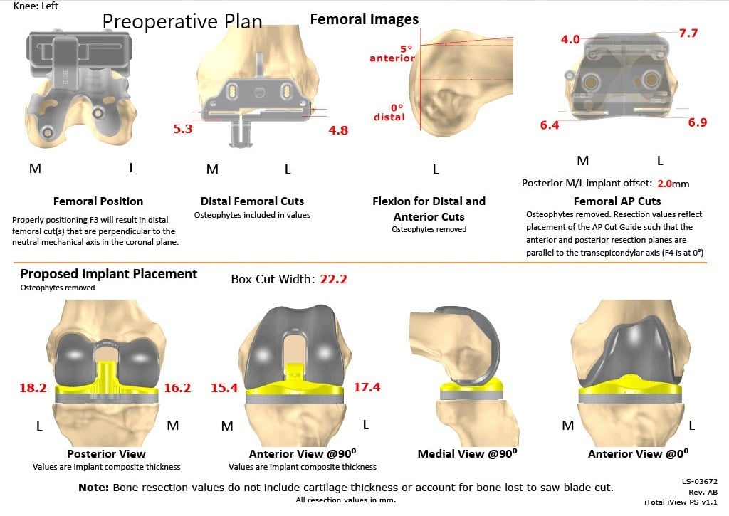 Complete Orthopedics patient specific surgical plan for a Left Custom Knee Replacement in a 67-year-old Female - scan 2