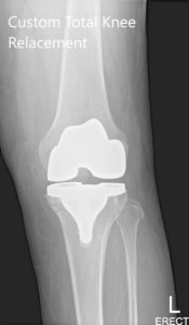 Post Operative X-ray images showing AP and lateral view of the left knee