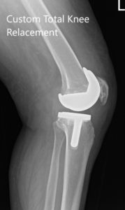 Post Operative X-ray images showing AP and lateral view of the left knee - img 2