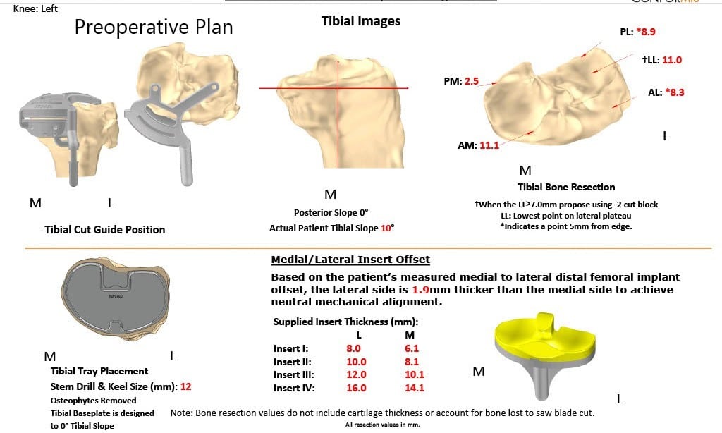 Complete Orthopedics patient specific surgical plan for a Left Custom Knee Replacement in a 70-year-old female