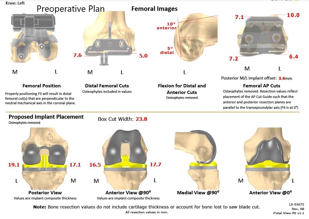 Complete Orthopedics patient specific surgical plan for a Left Custom Knee Replacement in a 70-year-old female - scan 2