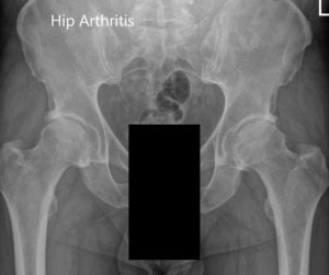 Preoperative X-ray of the pelvis AP view and the lateral view of the left hip