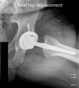 Imágenes radiográficas postoperatorias que muestran la vista AP y la vista lateral con patas de rana - img 2