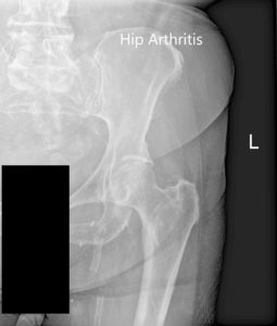 Radiografía preoperatoria de la cadera izquierda que muestra AP y vistas laterales de la anca y la anca de rana