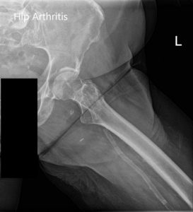 Radiografía preoperatoria de la cadera izquierda que muestra AP y vistas laterales de la pata de rana - img 2