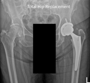 Imágenes radiográficas postoperatorias que muestran AP e imágenes laterales