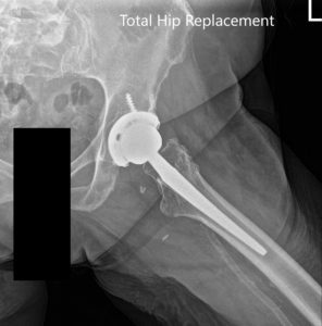 Radiografías postoperatorias que muestran AP e imágenes laterales - img 2