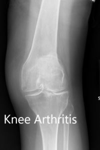 Preoperative X-ray showing the AP view of the left and the right knee respectively