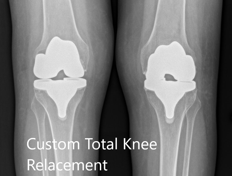 Postoperative X-ray showing the AP view of both knees