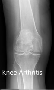 Preoperative X-ray showing the AP view of the left and the right knee respectively - img 2