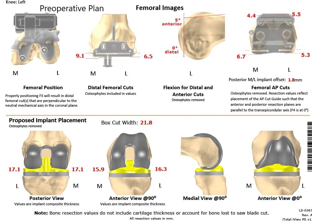 Complete Orthopedics patient specific surgical plan for a Bilateral Custom Total Knee Replacement in a 61-year-old male with Knee Arthritis & Genu Valgum Deformity - scan 2