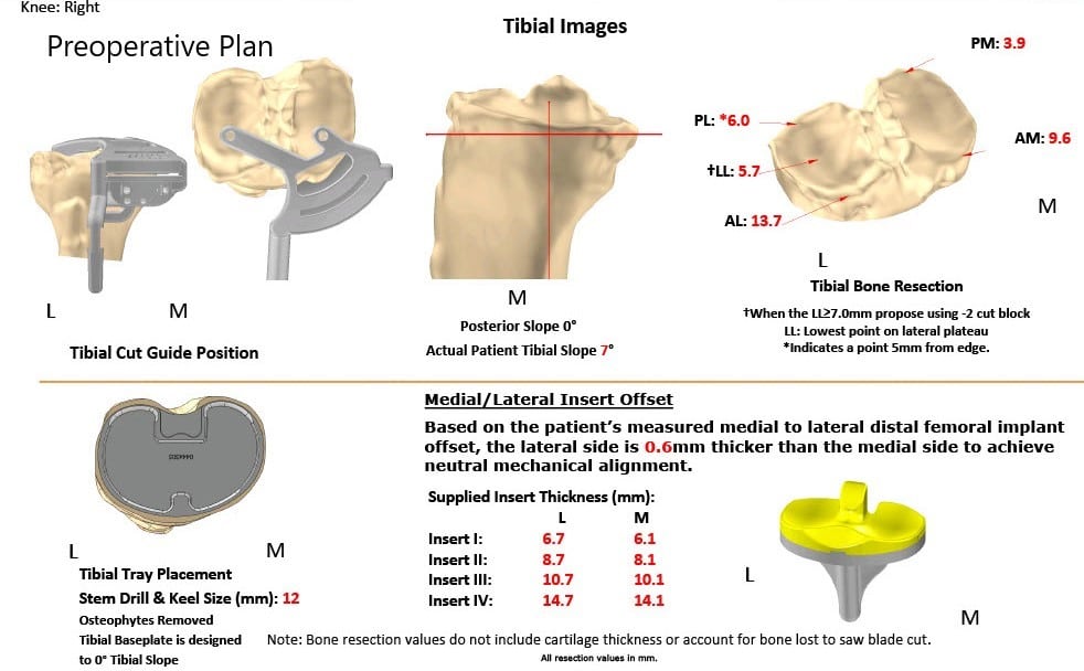 Complete Orthopedics patient specific surgical plan for a Bilateral Custom Total Knee Replacement in a 61-year-old male with Knee Arthritis & Genu Valgum Deformity - scan 3