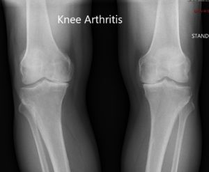 Preoperative X-ray showing the AP view of both the knee joints