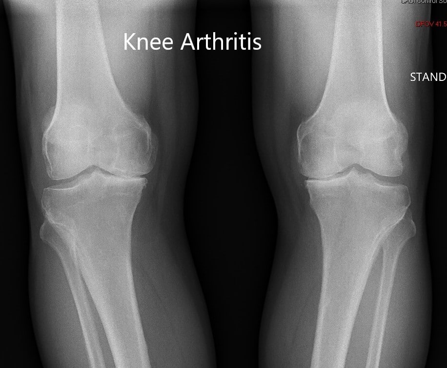 case study knee injury