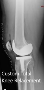 Postoperative X-ray showing the lateral view of the right and the left knee