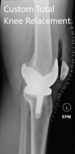 Postoperative X-ray showing the lateral view of the right and the left knee - img 2