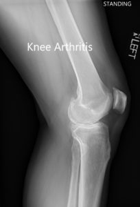 Preoperative X-ray showing the lateral view of the left and the right knee joint