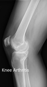 Preoperative X-ray showing the lateral view of the left and the right knee joint- img 2
