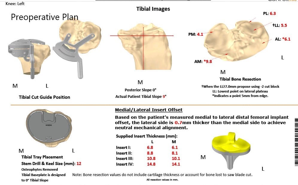 Complete Orthopedics patient specific surgical plan for a Bilateral Customized Total Knee Replacement in a 72-year-old female