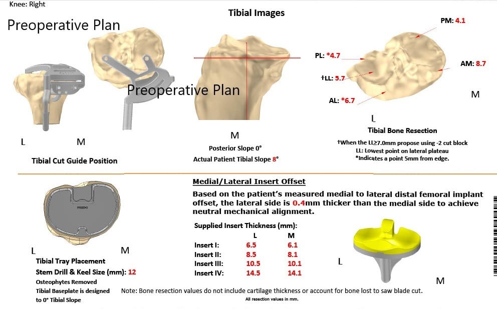 Complete Orthopedics patient specific surgical plan for a Bilateral Customized Total Knee Replacement in a 72-year-old female - scan 3