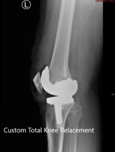 Postoperative X-ray showing the lateral views of both knees - img 2