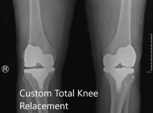 Postoperative X-ray showing the AP view of both knees