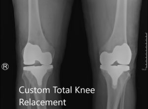Radiografía postoperatoria que muestra la vista AP de ambas rodillas