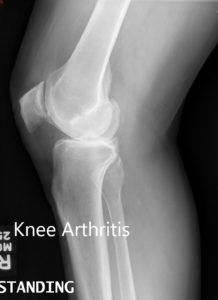 Preoperative X-ray showing the lateral views of the right and the left knee respectively