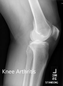 Preoperative X-ray showing the lateral views of the right and the left knee respectively - img 2