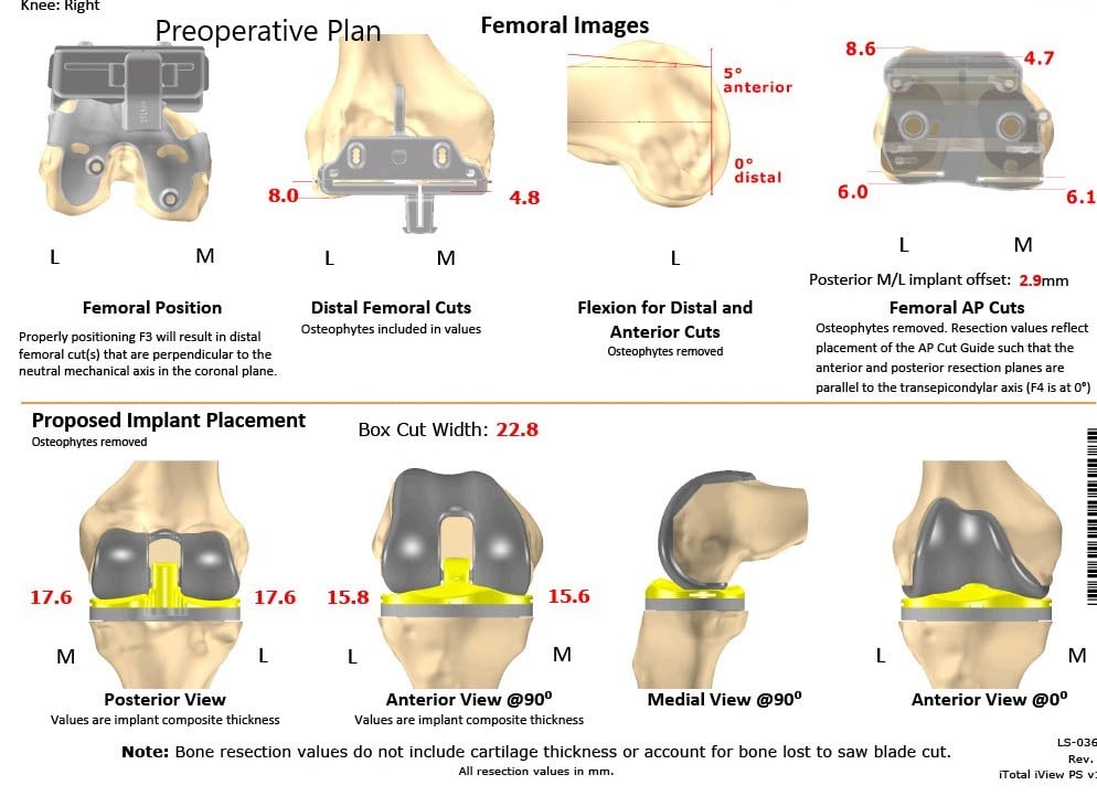 Complete Orthopedics patient specific surgical plan for a Bilateral Customized Total Knee Replacement in a 72-year-old patient with Arthritis - scan 2