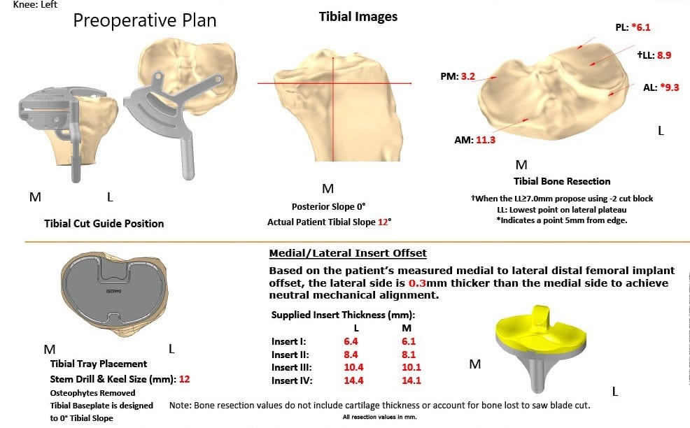 Complete Orthopedics patient specific surgical plan for a Bilateral Customized Total Knee Replacement in a 72-year-old patient with Arthritis - scan 3