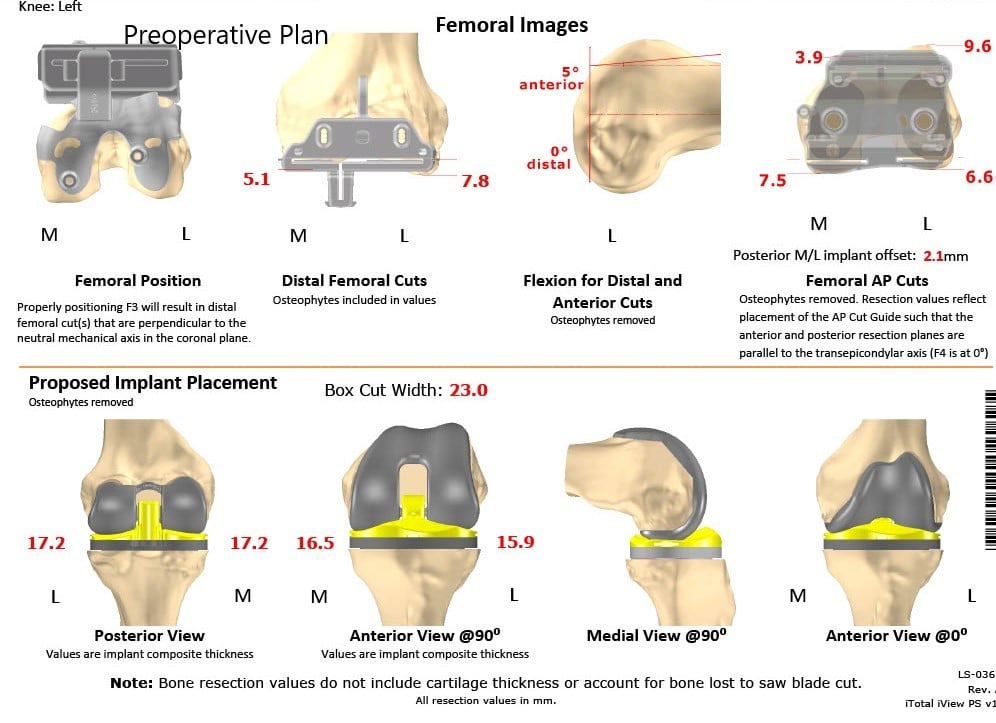 Complete Orthopedics patient specific surgical plan for a Bilateral Customized Total Knee Replacement in a 72-year-old patient with Arthritis - scan 4