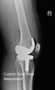 Postoperative X-ray showing the lateral views of both knees