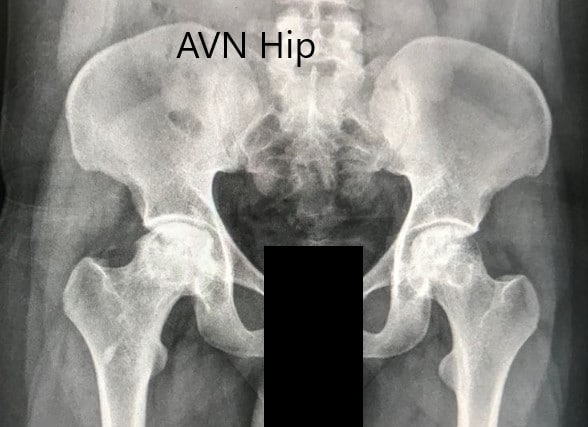 Preoperative X-ray of the pelvis with both hips in anteroposterior view showing AVN of both hips