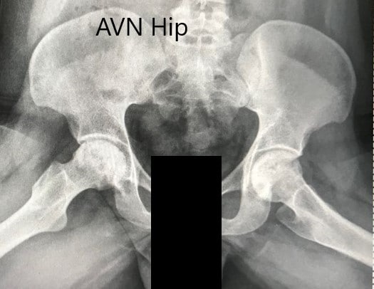 Preoperative X-ray of the pelvis with both hips in the frog-legged lateral view showing AVN of both hips