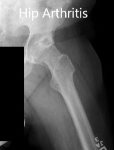 Preoperative X-ray showing the frog-leg lateral views of the right and the left hip joint - img 2