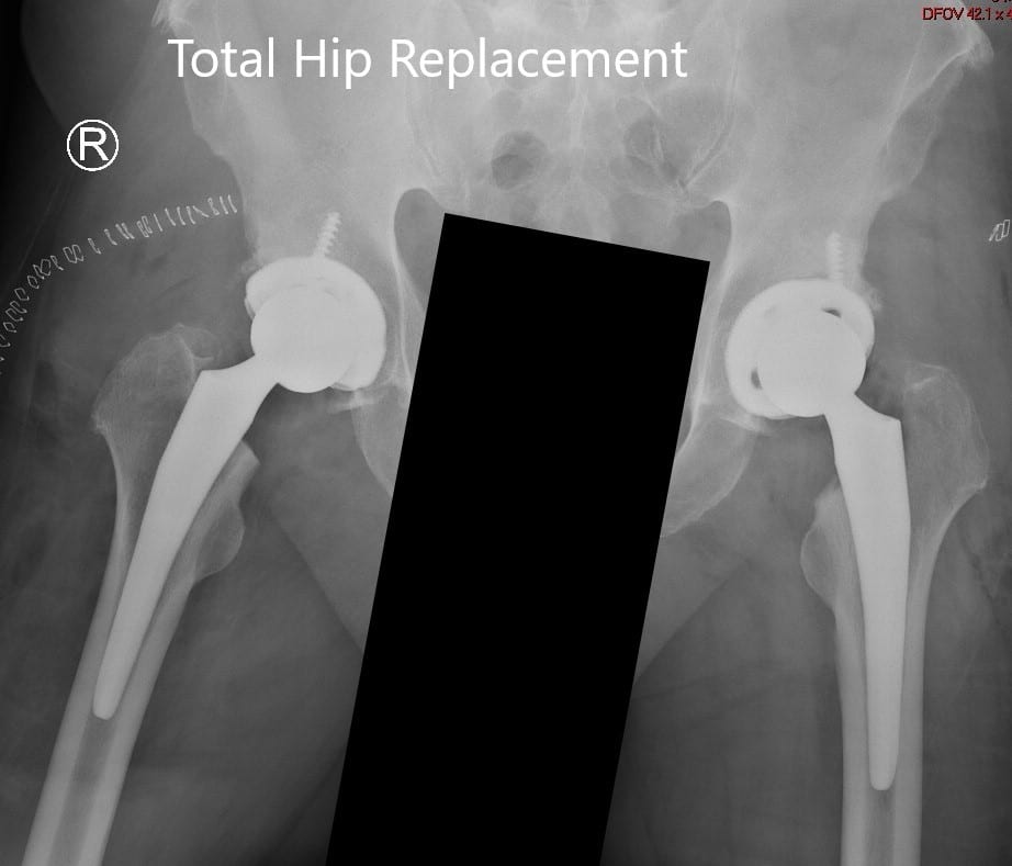 Case Study Bilateral Total Hip Replacement In A 74 Year Old Female