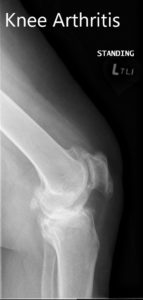 Preoperative X-ray showing the lateral and the AP views