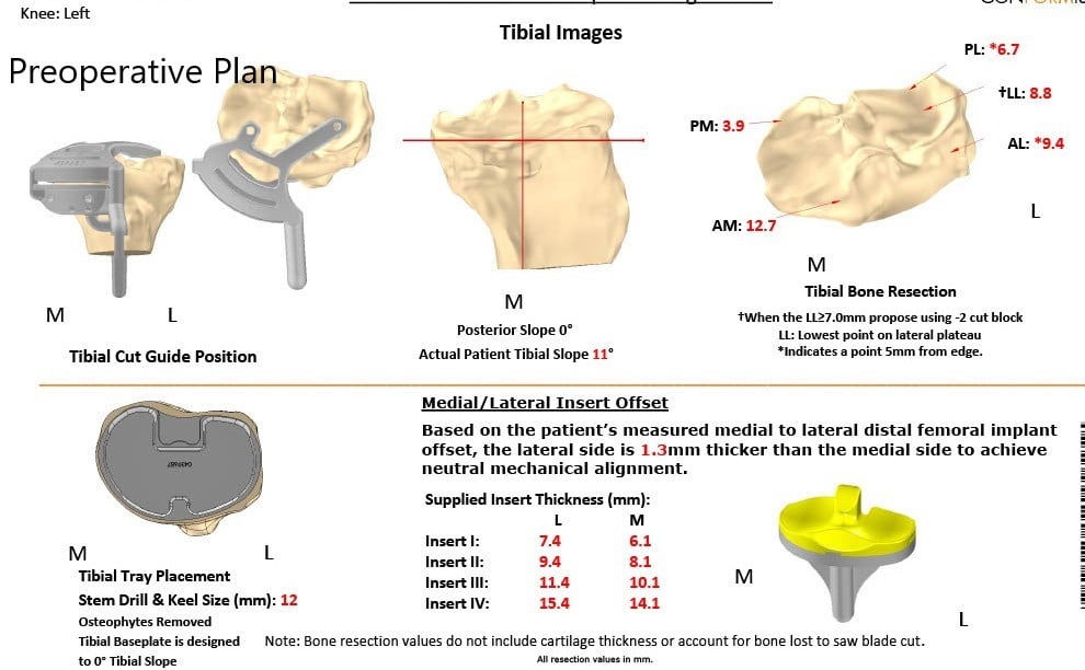 Complete Orthopedics patient specific surgical plan for a Custom Left Knee Replacement in a 71-year-old male