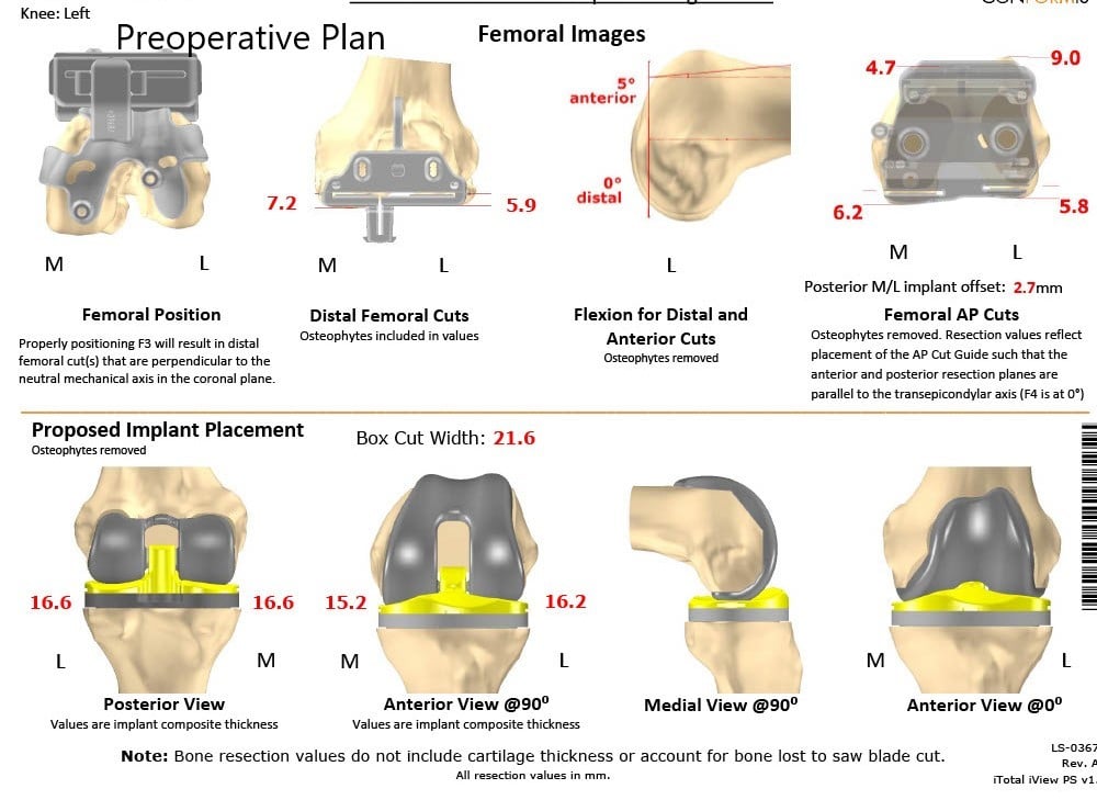 Complete Orthopedics patient specific surgical plan for a Custom Left Knee Replacement in a 71-year-old male - scan 2