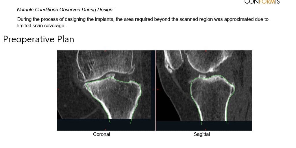 Complete Orthopedics patient specific surgical plan for a Custom Left Knee Replacement in a 71-year-old male - scan 3