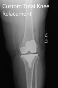Postoperative X-ray images showing the AP and lateral views of the left knee