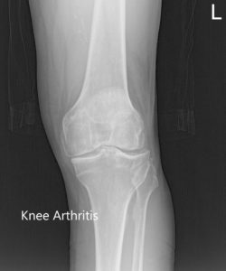 Preoperative X-ray of the left knee showing AP, lateral and merchant views