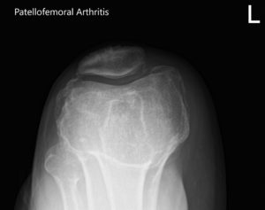 Preoperative X-ray of the left knee showing AP, lateral and merchant views - img 3