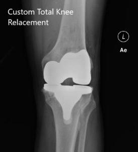 Postoperative X-ray of the left knee showing AP and lateral views