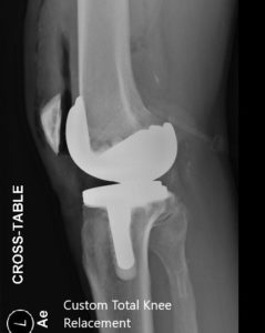 Postoperative X-ray of the left knee showing AP and lateral views - img 2