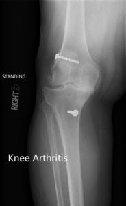 Preoperative X-ray showing the AP and lateral views of the right knee with retained screws consistent with ACL reconstruction